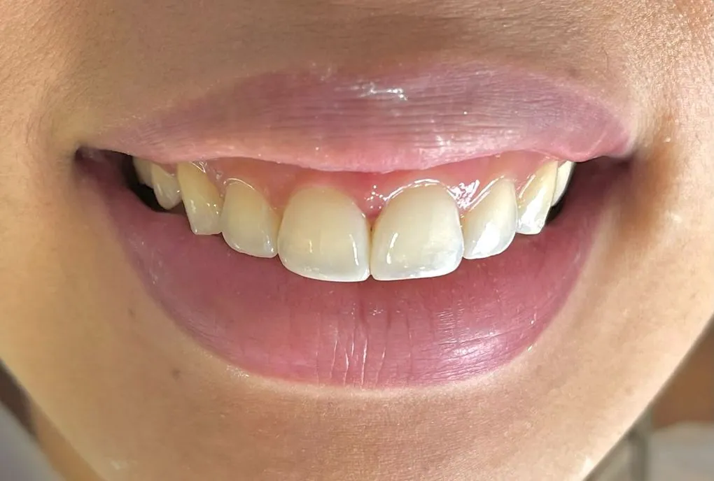 Depois: o mesmo sorriso, com o resultado do tratamento