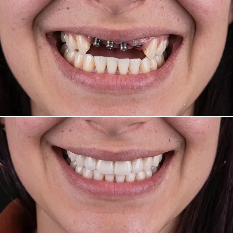 Antes e depois de implante dentário, caso real de paciente da Potenza Odontologia